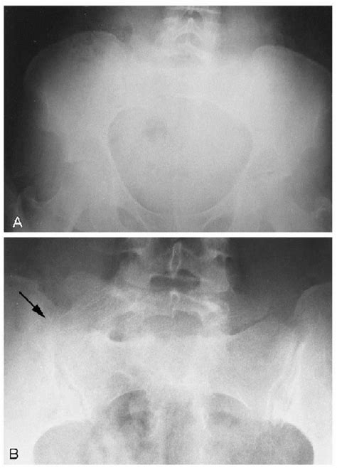 Ultimate Radiology Lumbosacral Transitional Vertebrae