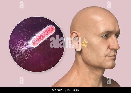 Pseudomonas Aeruginosa Bacterium Als Ursache Einer Otitis Media