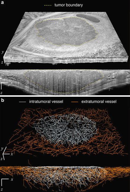 Optical Coherence Tomography In Cancer Imaging Ento Key