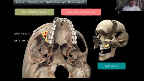 Lecture Infra Zygomatic Bone Screws Izc Upper Arch