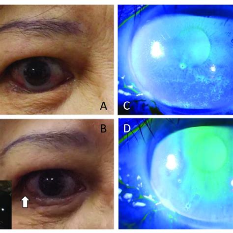 Comparison Of Parameters On Ocular Surface Disease In Different Time