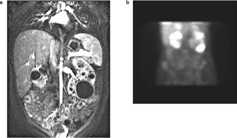 Infected kidney cysts - Kidney International