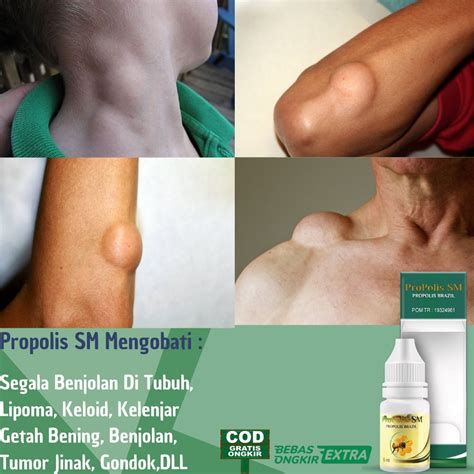 Jual Obat Penghilang Benjolan Lipoma Di Tangan Pundak Punduk Leher