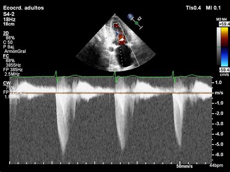 Qu Patr N De Doppler Se Puede Encontrar En La Miocardiopat A