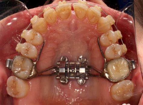 Maxillary Skeletal Expander Mse Lemke Orthodontics Sugar Land