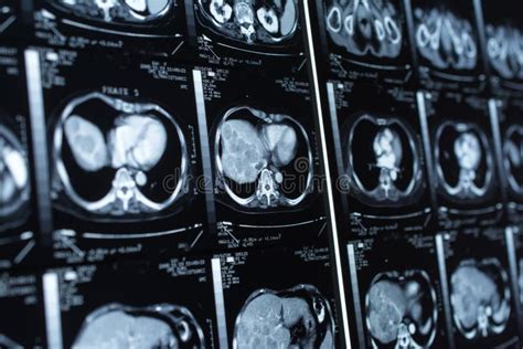 Ct Scan Brain Contrast Media Stock Photos - Download 51 Royalty Free Photos