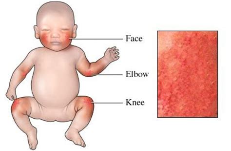 Pin On Brief Guidance On Different Types Of Eczematous Dermatitis