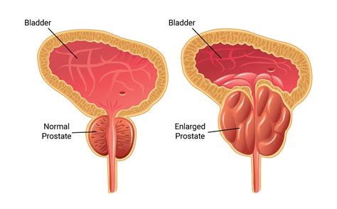 Urinary Retention – Phoenix, AZ – Enlarged Prostate – Ischuria