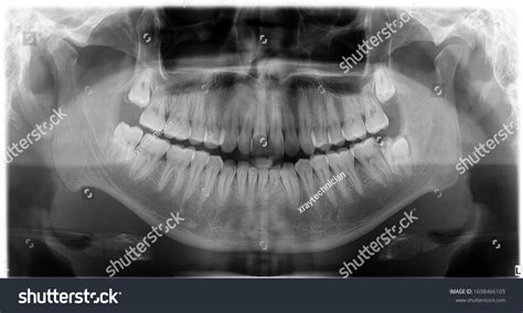 354 Wisdom Teeth X Ray Doctor Images, Stock Photos & Vectors | Shutterstock