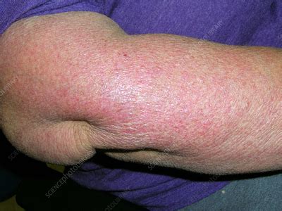 Dermatomyositis - Stock Image - C056/5420 - Science Photo Library