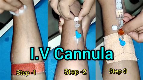 Iv Cannulation Step By Step Kaise Lagaye Veinflow Kaise Lagaye Iv