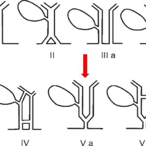 Modified Double Common Bile Duct Classification Proposed By Choi Et Al