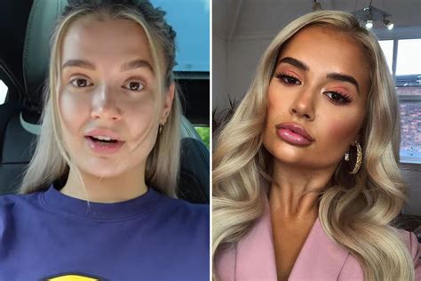 Molly Mae Hague Gets More Fillers Dissolved From Her Face But Admits