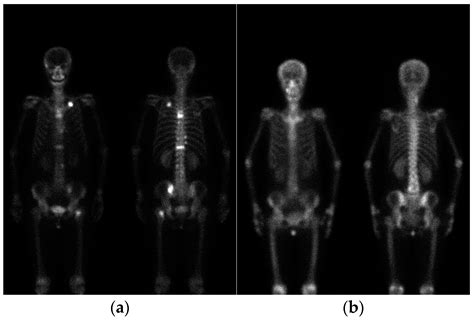 Nuclear Medicine Bone Scan