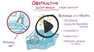 Sleep Apnea And Obesity Hypoventilation Syndrome Smarty PANCE