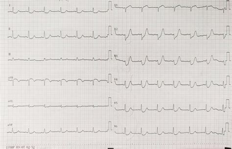 Emergency ECG showing de Winter ECG pattern | Download Scientific Diagram