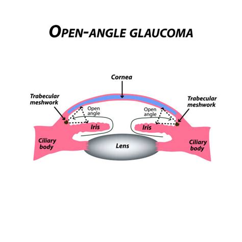 Glaucoma Illustrations Royalty Free Vector Graphics And Clip Art Istock