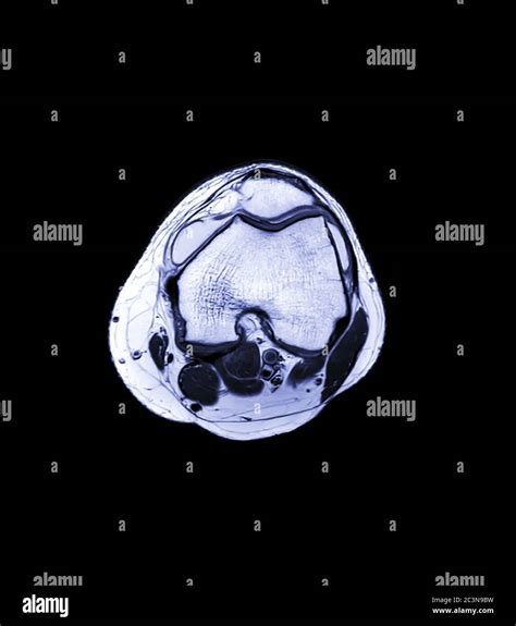 MRI Knee Joint Or Magnetic Resonance Imaging Axial For Detect Tear Or