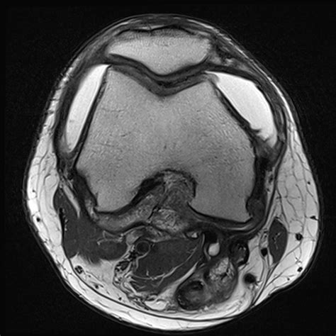 Pigmented Villonodular Synovitis Image Radiopaedia Org