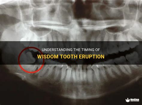 Understanding The Timing Of Wisdom Tooth Eruption Medshun