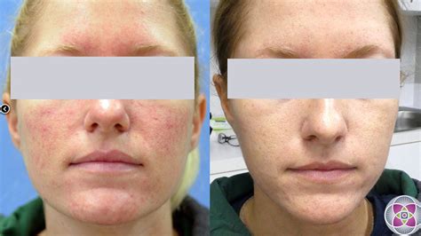 Vbeam Laser Treatment Uk The Best Picture Of Beam