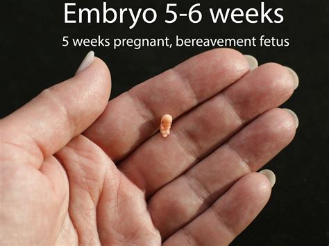 Mother Shares Moving Photos Of Baby Miscarried At 15 Weeks He Was A