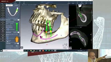 Cad Lynx Evolution Chirurgia Guidata YouTube