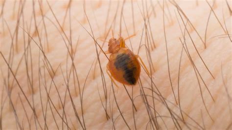 Bed Bug Bites Pictures Symptoms Treatment And Prevention