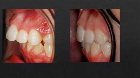 Overjet Before And After