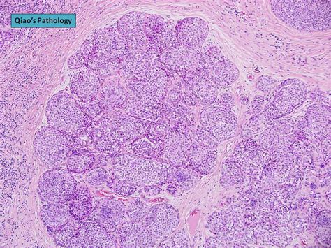 Qiao S Pathology Lobular Carcinoma In Situ Lcis A Photo On Flickriver