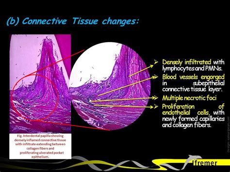 Periodontal Pockets And Its Pathogenesis Ppt Download