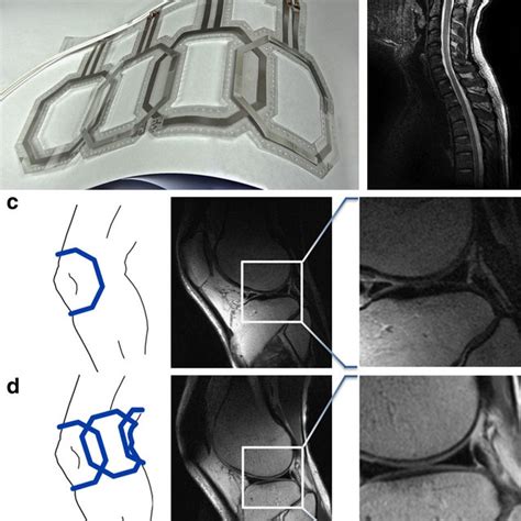 Pdf Screen Printed Flexible Mri Receive Coils