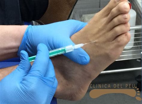 Columpio Postre Descarte Neuroma De Morton Infiltracion En Todo El