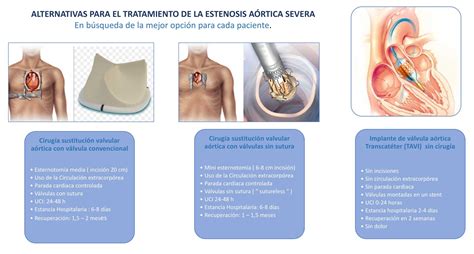 Los Procedimientos Tavi Han Revolucionado El Tratamiento De La