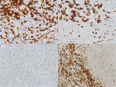 A, CD3‐positive cells are seen around the tumor mass. B, CD20‐positive ...