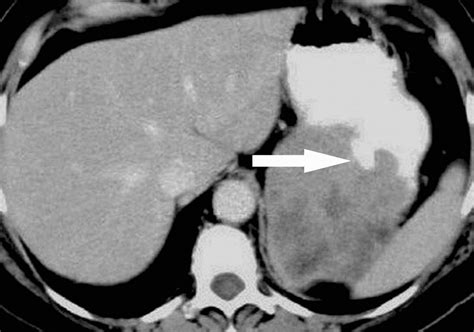 Gastrointestinal Stromal Tumors Clinical Radiologic And Pathologic Features Ajr