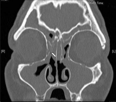 Lateralised right middle turbinate. A coronal C.T scan of a patient ...