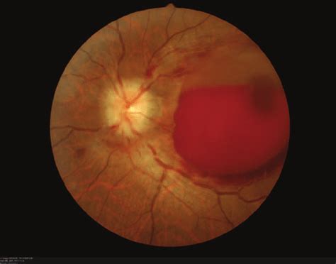 Fundus Photographs Showing Subhyaloid Hemorrhage In Posterior Pole In