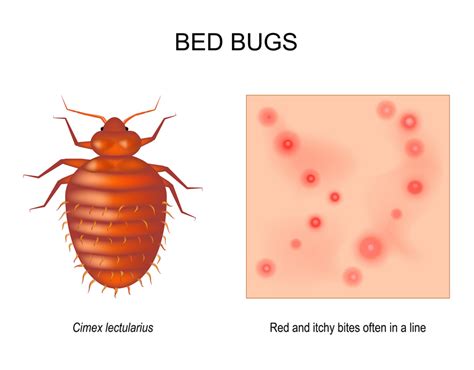 Bed Bug Bites Pictures Symptoms What Do They Look Like Heat Rx