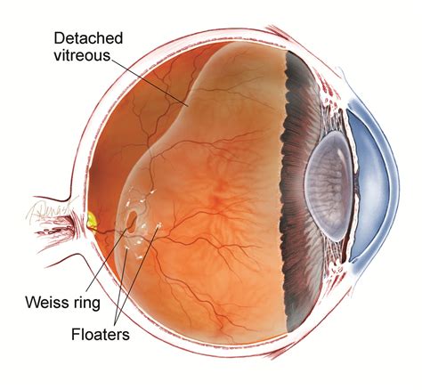 Understanding Eye Floaters & Flashes: Causes, Symptoms, and Treatments