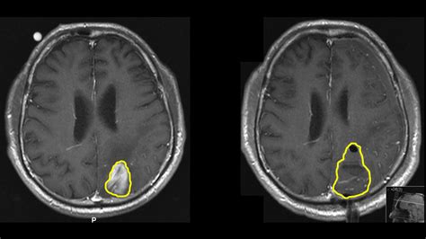 Glioblastom Neurochirurgie Inselspital Bern