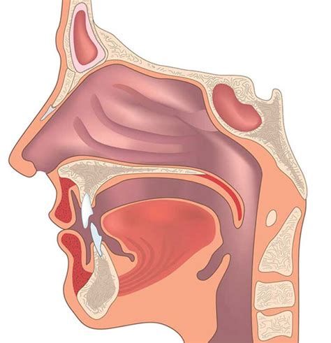 Subglottic Stenosis UCI Head And Neck Surgery UCI ENT Doctors