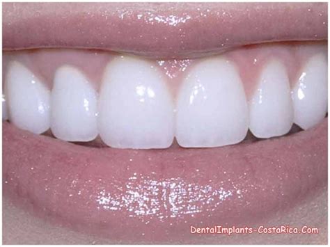 Emax Dental Crowns In Costa Rica Dental Implants In Costa Rica