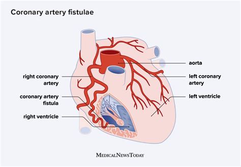 What Is A Coronary Artery Fistula