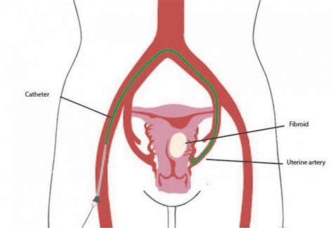 Uterine Fibroid Embolisation Dr Ryan Mcconnell Kingswood Sydney