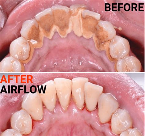 Why Use Airflow Ems For Teeth Cleaning Heritage Dental Group