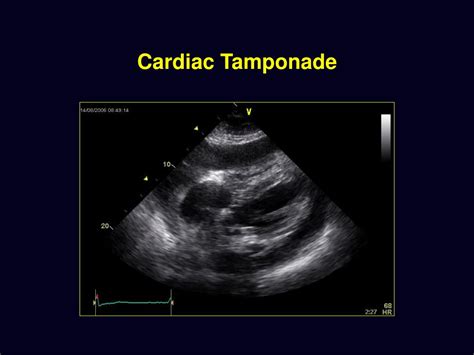 Ppt Basic Echocardiography Powerpoint Presentation Free Download