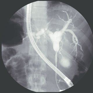 Endoscopic Retrograde Cholangiopancreatography Ercp Showing Focal