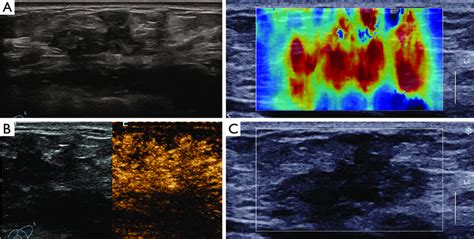 Multimodal Ultrasound Images Of A Year Old Woman With Invasive