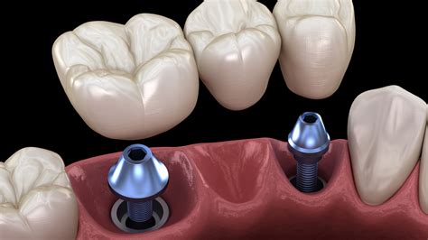 Basal Dental Implants: Understanding the controversies around them